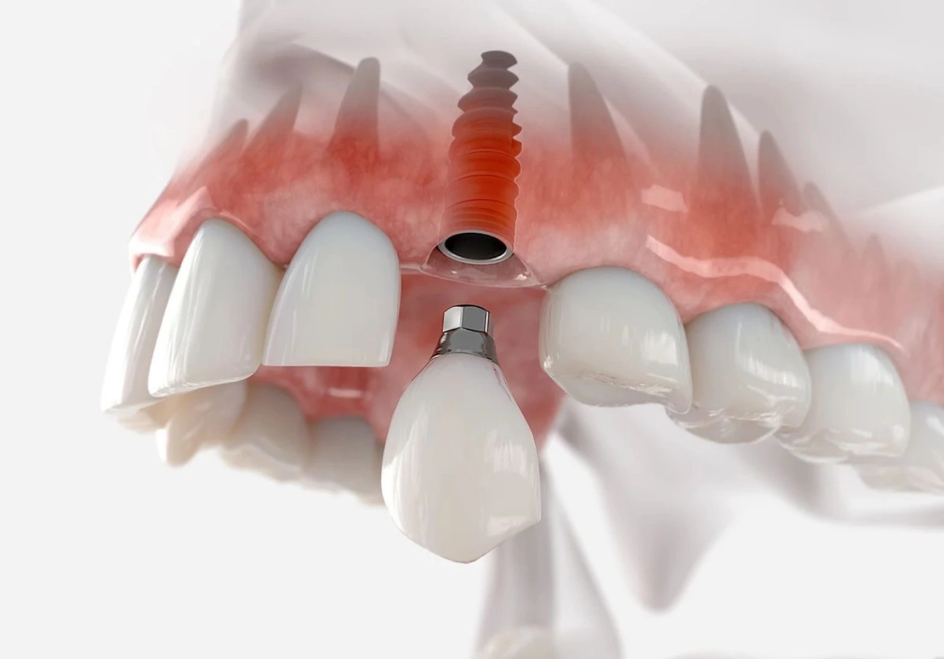 SINGLE DENTAL IMPLANT BY DR NIKHIL OBERAI