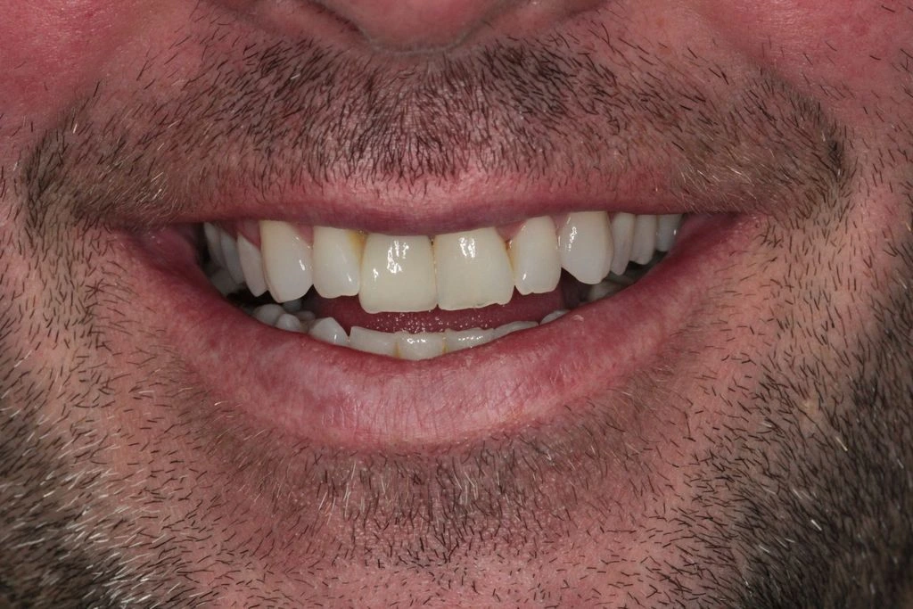 DR NIK IMPLANT CASE 1- AFTER DR NIK IMPLANT CASE 1- AFTER