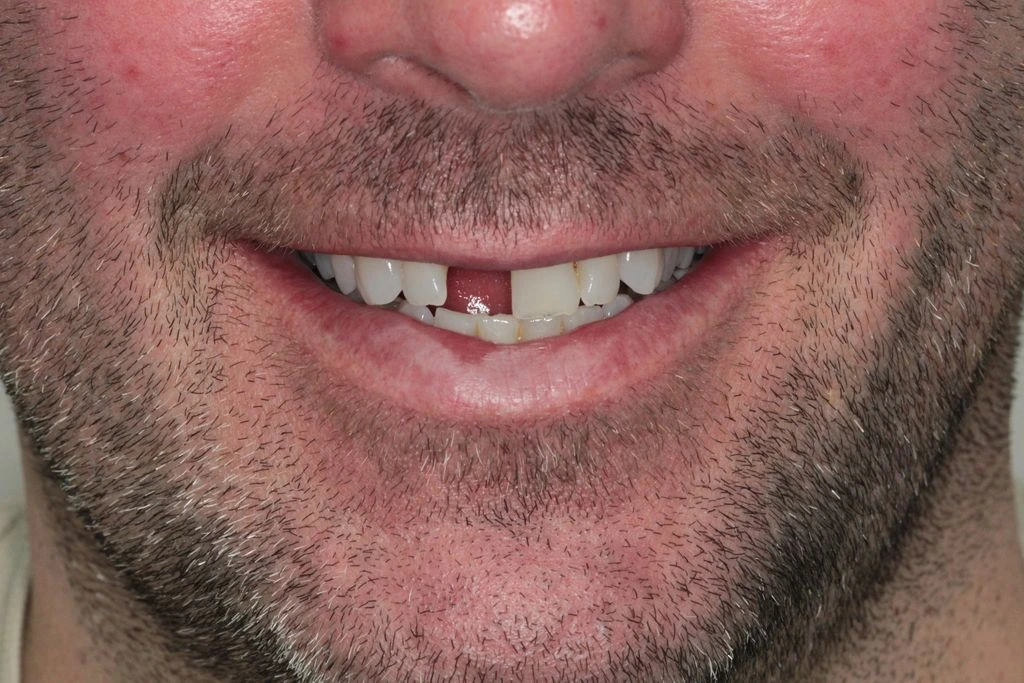 DR NIK IMPLANT CASE 1- BEFORE