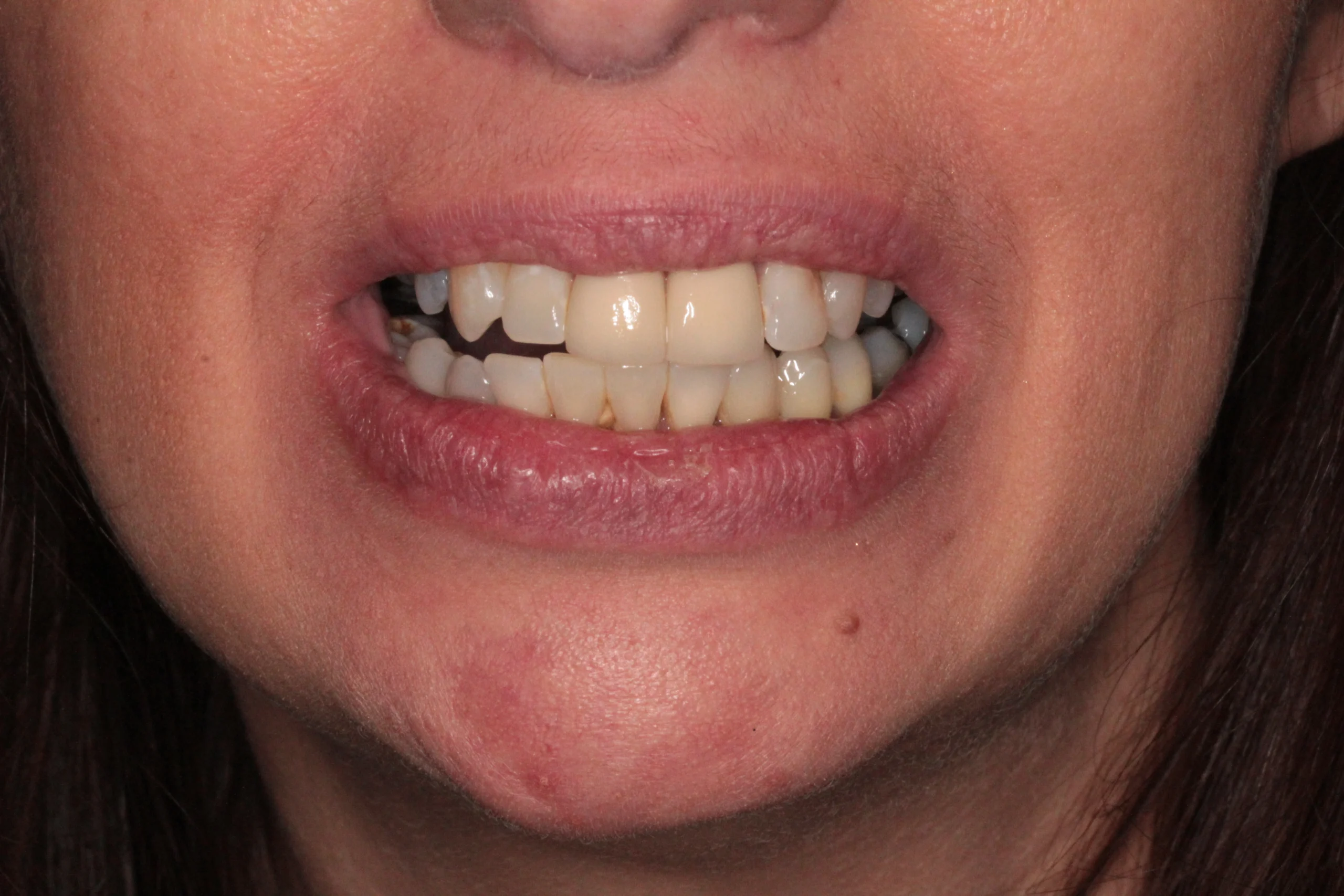 DR NIK IMPLANT CASE 2 – AFTER. DR NIK IMPLANT CASE 2 - AFTER.