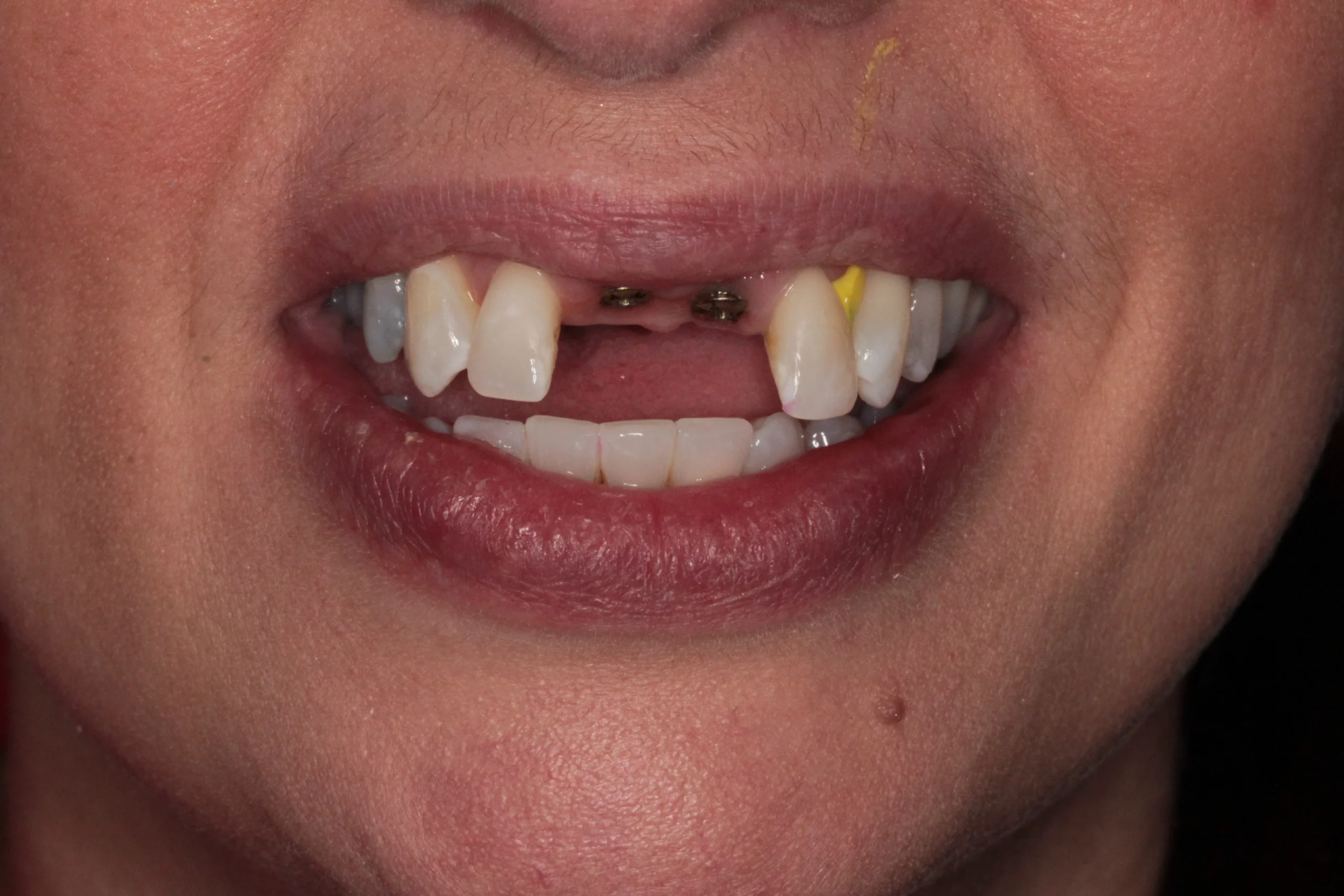 DR NIK IMPLANT CASE 2 - BEFORE.